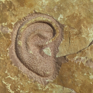 Tinnitus